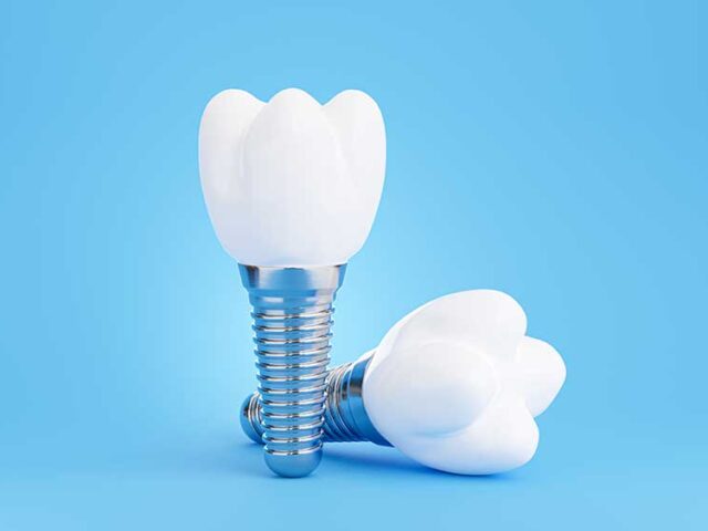 Tooth Implants, Treatment Planning, and Design