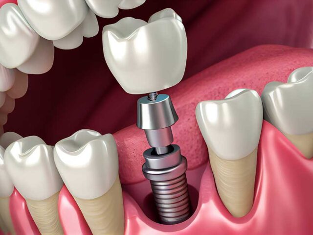 Dental Implant Surgery, Restoring Smiles with Brea Family Dentistry