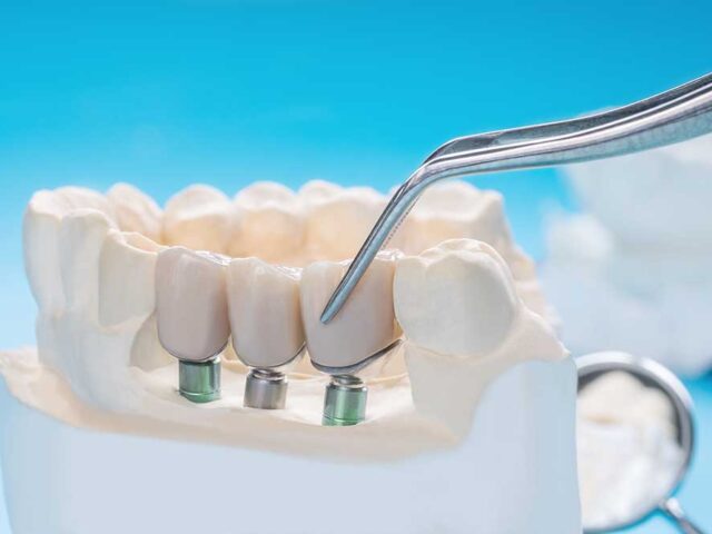 Tooth Implants and the Prevention of Further Damage