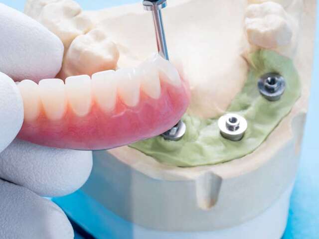 Implant Placement Step