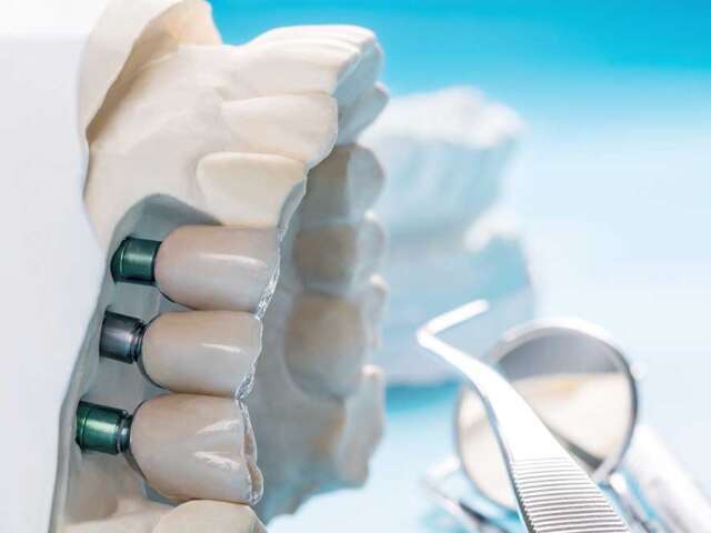 Understanding Implant Dentistry