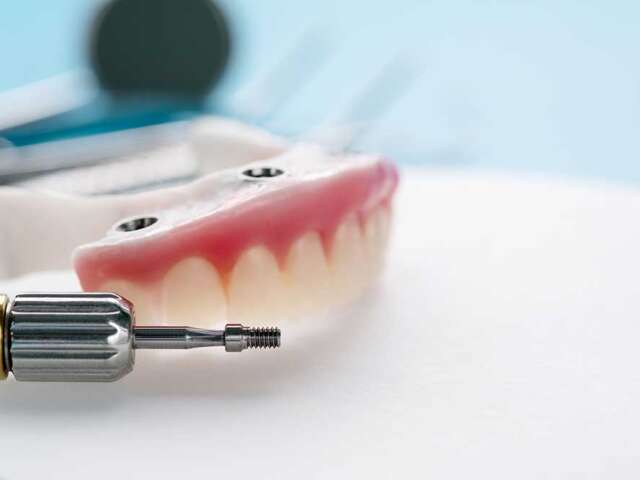 Procedure Steps for Dental Implants