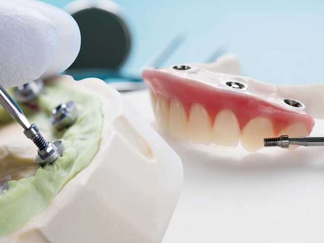 What are Tooth Implants?