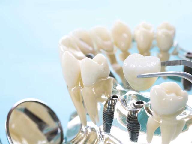 Tooth Implants, Restoring Smiles