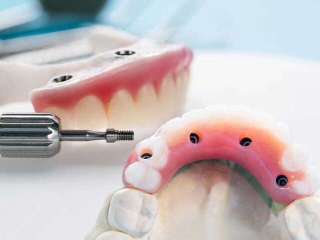 Tooth Implant vs. Traditional Solutions