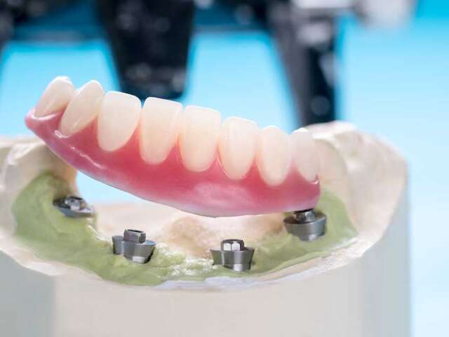 Tooth Implants Comprehensive Treatment Plans