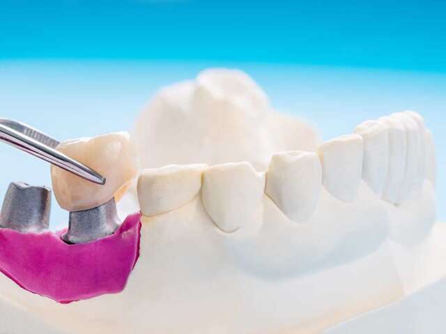 Decoding of the Harmony of Tooth Implant and Bone Integration