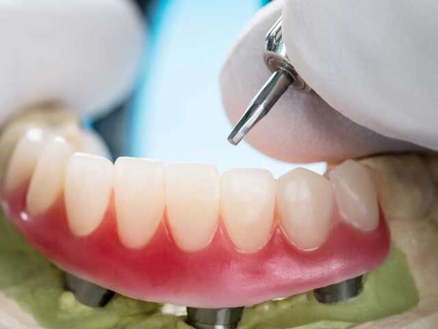 Tooth Implants Initial Consultation and Examination