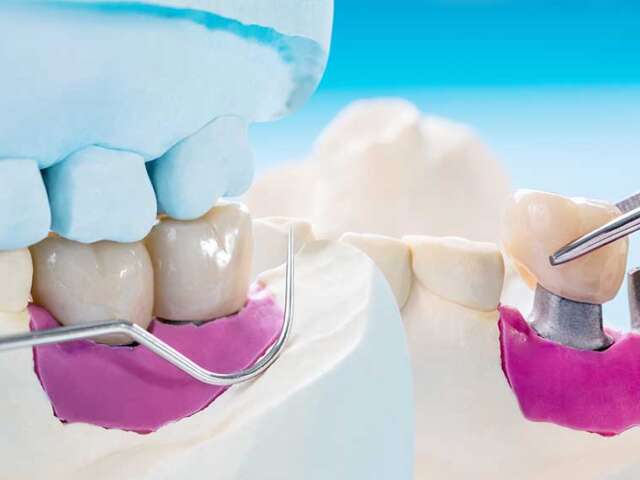 Tooth Implants, Understanding Implant-Bone Bonding Factors